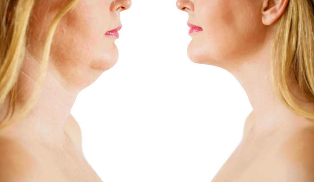 Double Chin treatment Livingston before and after results