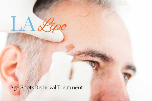 What Are the Most Effective Treatments for Age Spots Livingston?