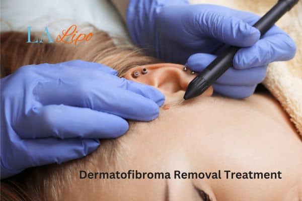 Dermatofibroma Removal Treatment Livingston