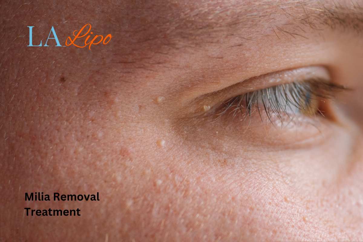 Cryopen Milia Removal: Is It the Easiest and Safest Option Livingston?