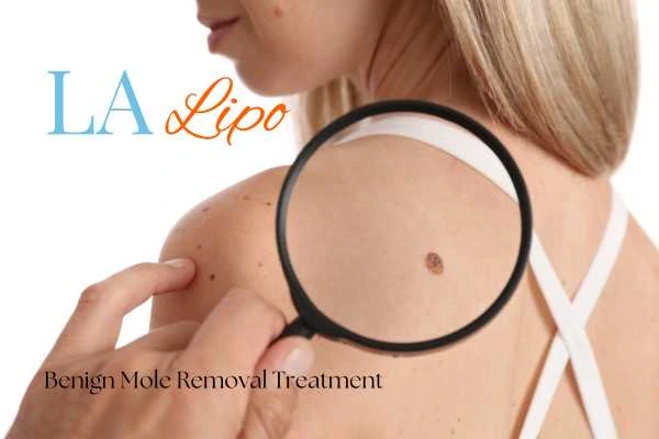 Why getting moles removed Livingston can boost your confidence!