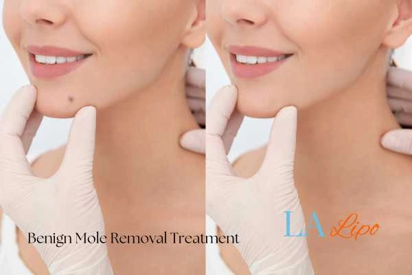 woman's before and after mole removal Livingston results