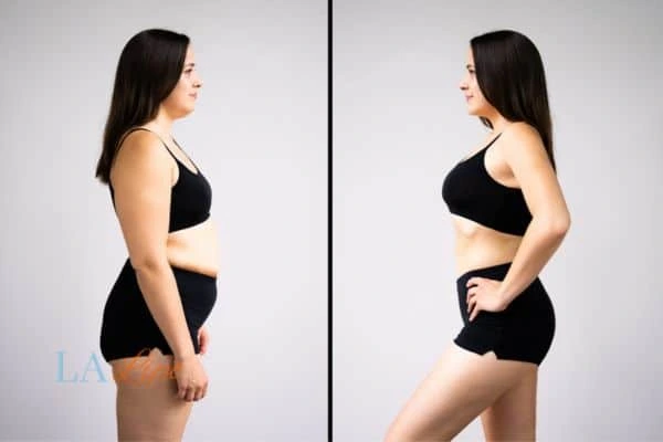 image of woman before and after results of LA-EMS Body Sculpting Livingston to help treat Diastasis recti