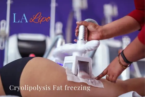 women getting fat freezing Livingston