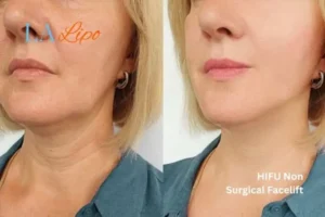 hi-fu for wrinkles Livingston before and after results