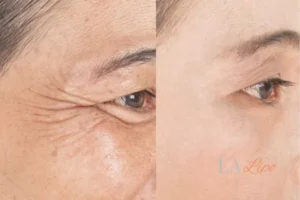 Before and after results of woman - HI-fu wrinkles reduction treatment Livingston