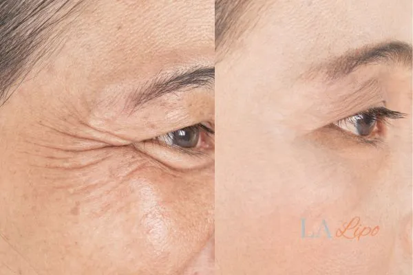 Before and after results of woman - HI-fu wrinkles reduction treatment Livingston