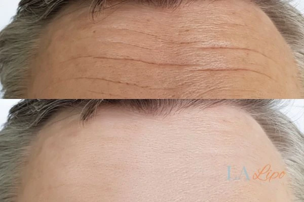 results of HIFU Livingston on mans forehead to help reduce lines and wrinkles
