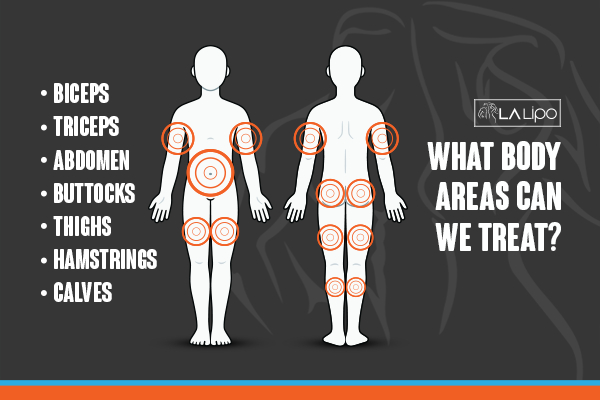 Graphic to show areas you can have LA-EMS Body Sculpting Livingston treatment.