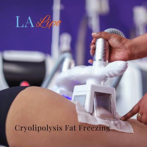 fat freezing - Cryolipolysis Livingston