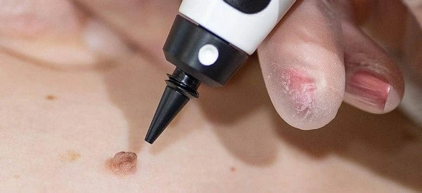 skin tag removal using cryopen Livingston