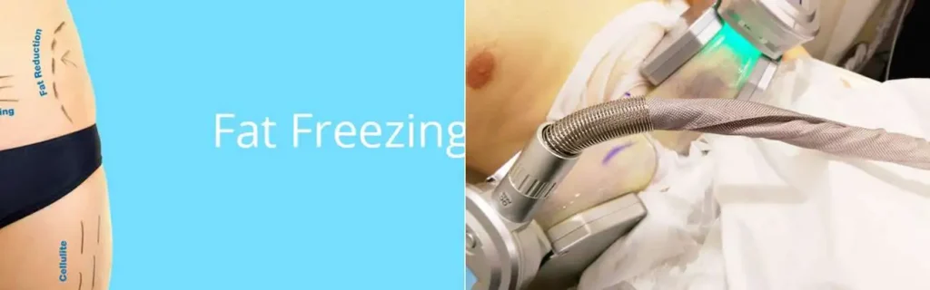 multi areas of a persons body having coolsculpting Livingston treatment