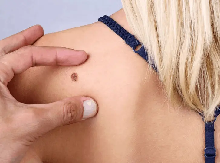 woman having mole removal Livingston consultation before treatment.