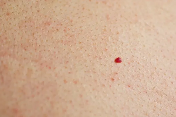 close up of a cherry angioma Livingston
