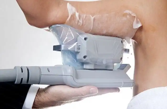 Picture of fat freezing Livingston on the upper arms.