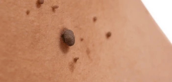 image of a skin tag Livingston