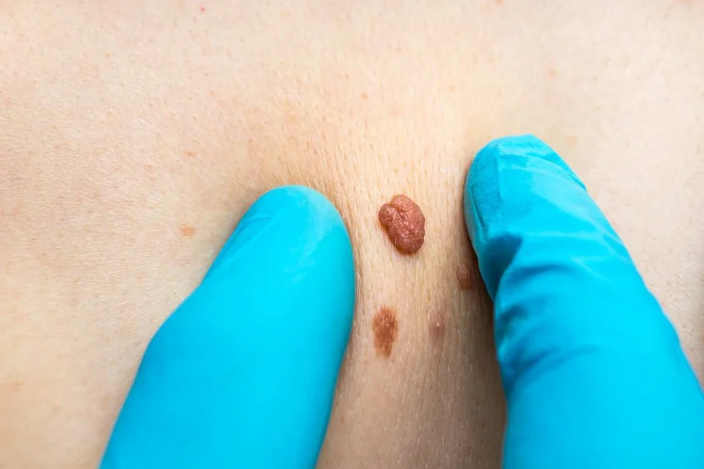 Consultant examining a skin tag Livingston