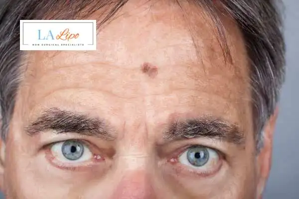 Solar Lentigo Removal Livingston image of man with mark on his forehead
