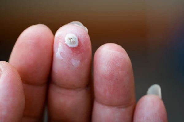 wart on person finger - cryotherapy to treat from LA LIPO Livingston