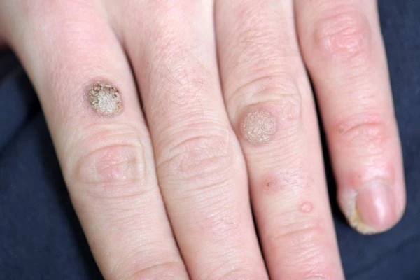 photo of warts on person hand - see wart removal Livingston from LA LIPO