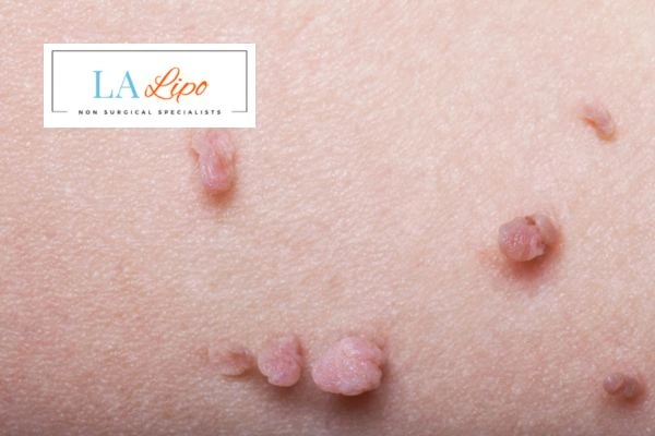 Does cryopen skin tag removal Livingston hurt? Find out now call our team today!