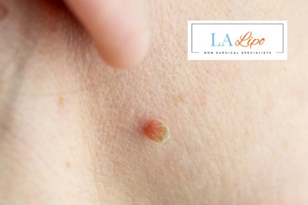 Book skin tag removal Livingston today speak to our team now!