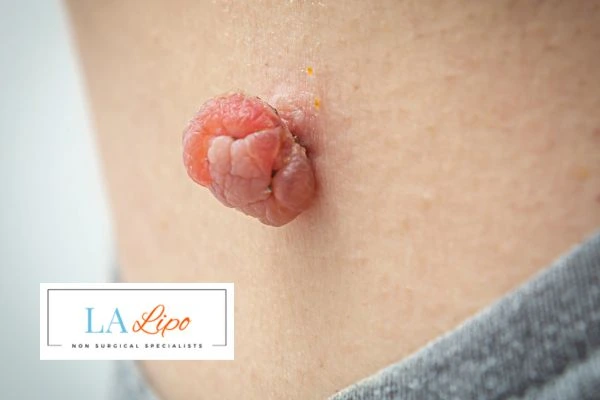 Interested in skin tag removal Livingston? Concerned about the pain? Find out more today!