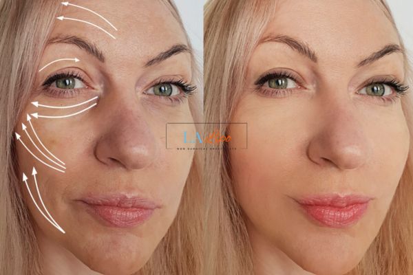 Morpheus 8 results Livingston face lift.