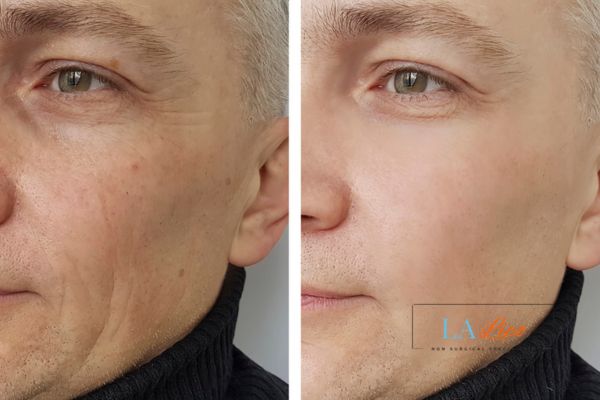 See the amazing results of Morpheus8 Treatment Livingston!