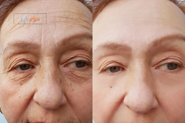 The powerful benefits of Morpheus8 Treatment Livingston - Call Our team today!