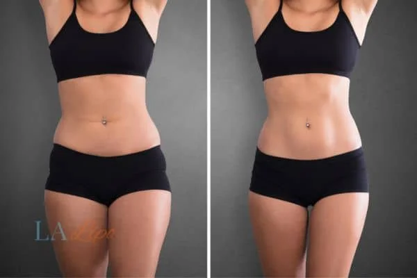 before and after results of non-surgical treatment to help a woman's body image and mental health Livingston
