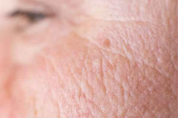 close up picture of a woman's face showing an age spot Livingston