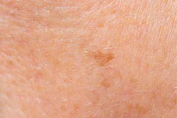 close up picture of age spots Livingston