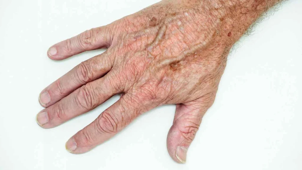 Male hand showing age spot Livingston
