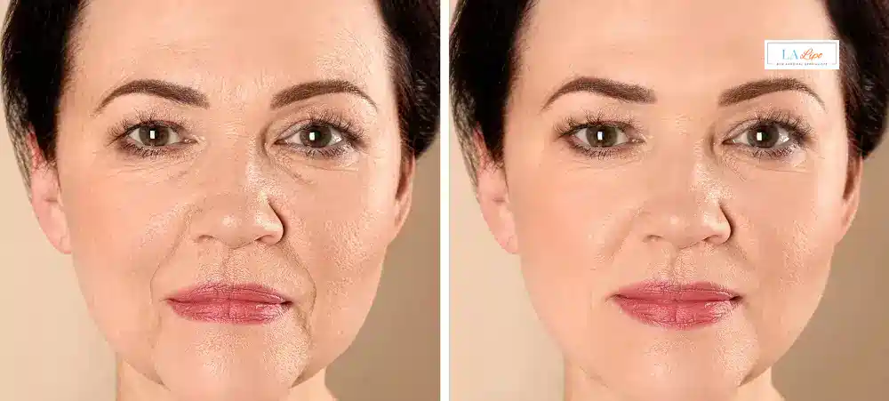 How Long Does It Take to See Results and How Long Do They Last Livingston?