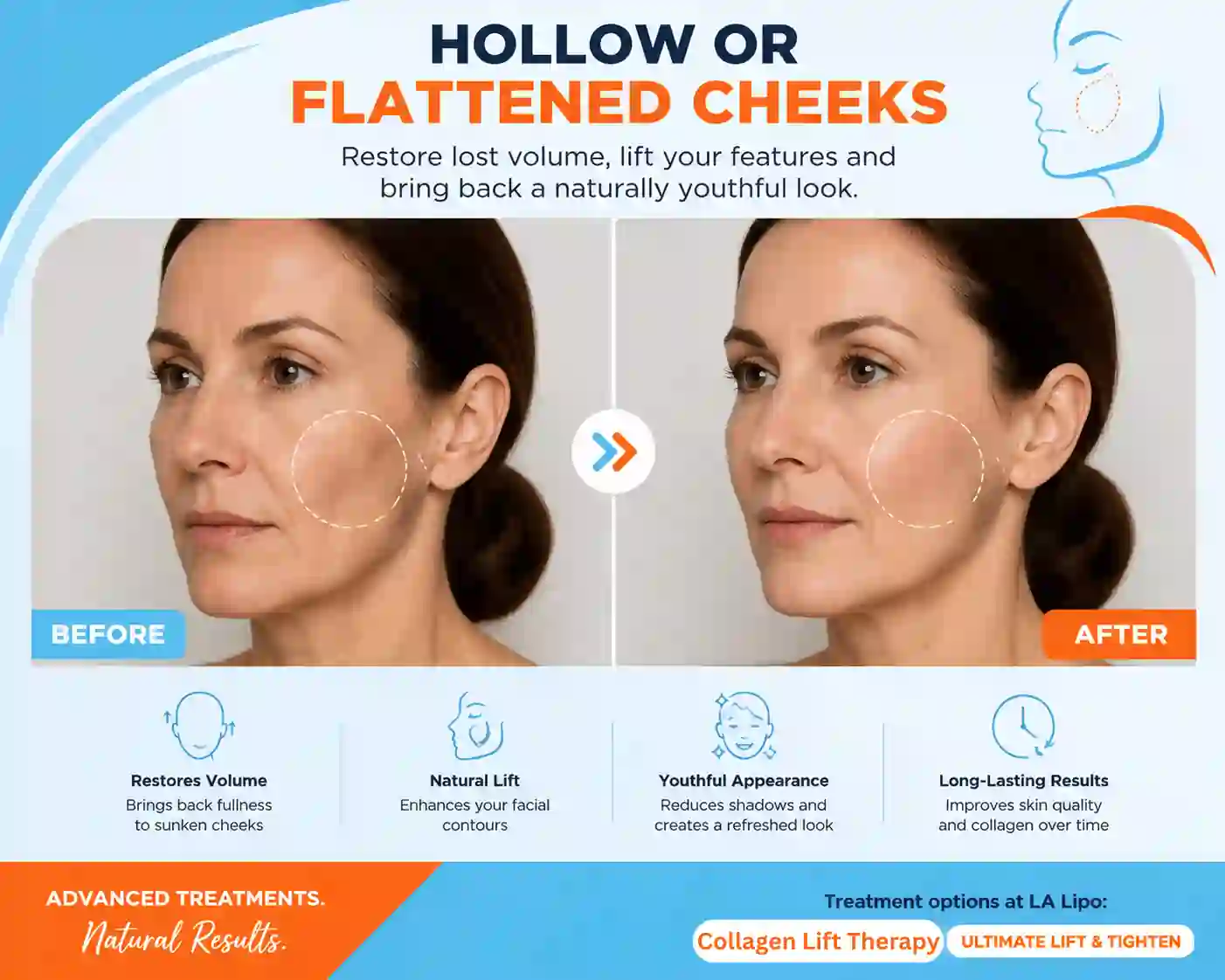 Sign #4: Hollow or Flattened Cheeks Livingston